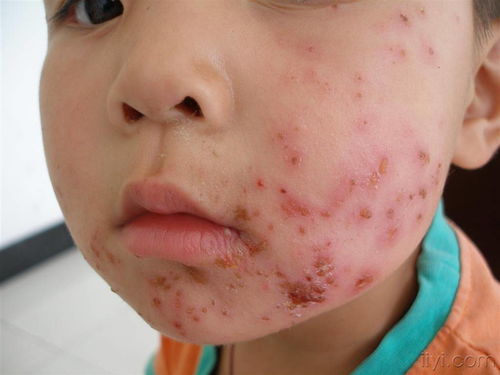 膿包瘡的注意事項