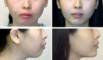 術(shù)后,下巴,注意事項