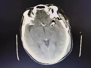 腦動(dòng)脈瘤夾閉術(shù)后注意事項