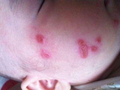 蛇顆瘡注意事項