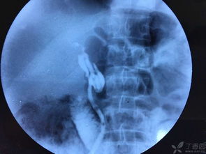 肝臟,術(shù)前,注意事項