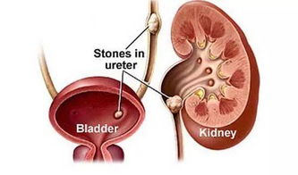 術(shù)后,結石,注意事項,尿路