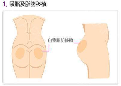 屁股粉瘤手術(shù)后注意事項,屁股腫物手術(shù)后注意事項,屁股激光手術(shù)后注意事項