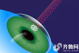 術(shù)前,注意事項,屈光