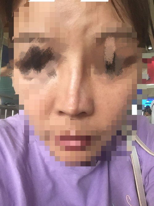 隆鼻術(shù)后的10大注意事項,隆鼻術(shù)后飲食注意事項,肋骨隆鼻術(shù)后注意事項