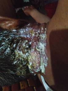 蛇盤(pán)瘡飲食需要注意什么,蛇盤(pán)瘡注意飲食禁忌,蛇盤(pán)瘡患者飲食禁忌