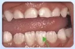 撥下門(mén)牙的注意事項,種植門(mén)牙注意事項,補完門(mén)牙注意事項