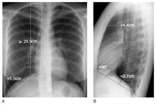 肺氣腫上青海的注意事項