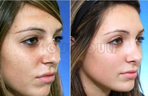 冰點(diǎn)波拉皮注意事項