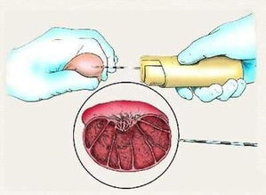 睪丸穿刺活檢注意事項