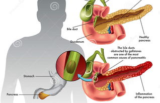 胰腺腫瘤注意事項