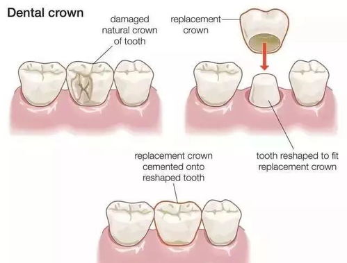 根管填充后注意事項