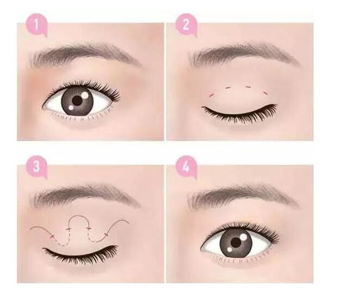 割雙眼皮注意事項?,做完雙眼皮睡覺(jué)注意事項,割雙眼皮前期注意事項