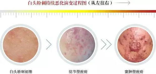 粉刺,注意事項,清理