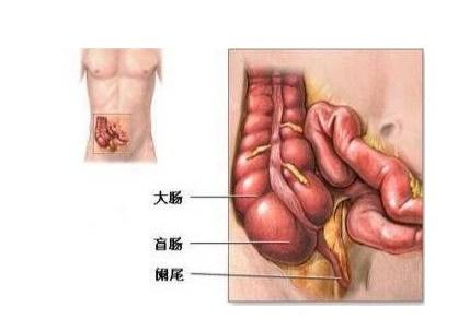 闌尾炎微創(chuàng  )手術(shù)后注意事項,闌尾炎吊水好了以后注意事項,闌尾炎手術(shù)后注意事項和飲食