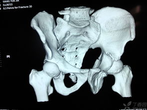 髖關(guān)節復位后注意事項,頸椎復位后的注意事項,腰復位后需要注意事項