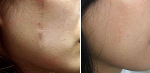 激光去色素疤痕后有什么注意事項