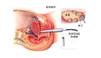 試管取卵前1天注意事項