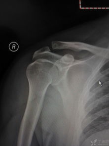 肩鎖關(guān)節脫位保守治療后遺癥,肩鎖關(guān)節脫位保守治療能治愈,肩鎖關(guān)節脫位保守治療恢復時(shí)間