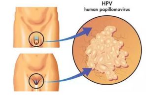 尖銳濕疣,北京,注意事項,軍都診