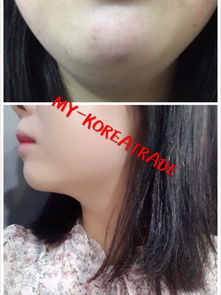 vline溶脂針后注意事項