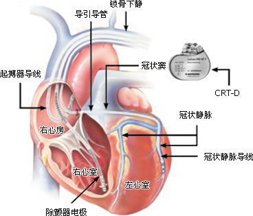 體外起搏器注意事項