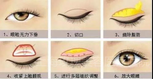 換眼睛手術(shù)后注意事項