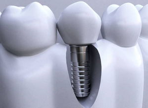 種牙第二期后注意事項