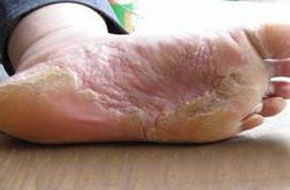 癬菌疹注意事項