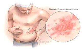 帶狀皰疹,注意事項