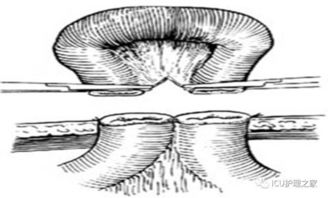 結腸灌洗術(shù)注意事項