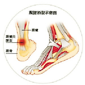 跟腱,康復,注意事項