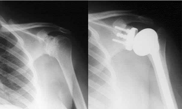 肩關(guān)節基礎知識